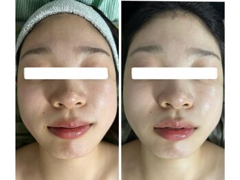 ビジュープラス 幸手店(Bijou+)/美白・シミケア