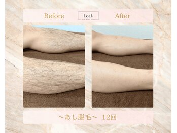 リーフ(Leaf.)/あし脱毛