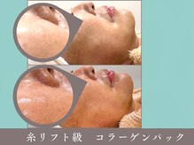 プレジール(plaisir)/糸リフト級のコラーゲンパック