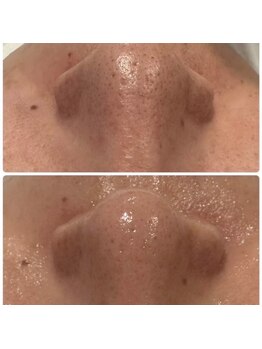 サロン ド ミコラ(salon de Micora)/次世代美容液毛穴洗浄!