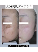 マイン 幸店/ドクターリセラADS美肌活性