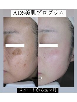 マイン 幸店/ドクターリセラADS美肌活性