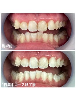 ホワイトニングサロン 京都烏丸店/ホワイトニング施術例