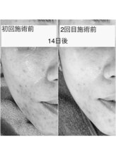 サロン ヴィーナス(VENUS)/ＶＥＮＵＳ美肌プラズマの例