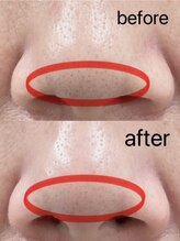 シェリー(Cheri)/ハナ毛穴洗浄吸引