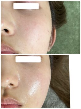 ビジュープラス 幸手店(Bijou+)/美白・シミケア