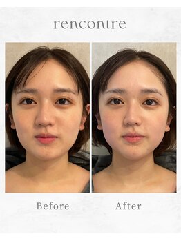 ランコント(rencontre)/毛穴/ヘッドスパ/小顔/リンパ