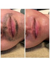 ビューティーサロンエイト(Beauty Salon8)/男性ヒゲ脱毛