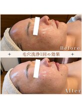 ルメリア(Lumelia)/毛穴洗浄ビフォーアフター