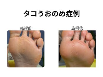 ドクターネイル爪革命 和歌山/胼胝魚の目