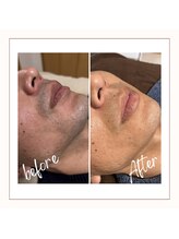 フルールスレーヌ(Fleur Sereine)/清潔感が一番☆本気の髭脱毛