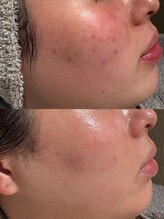 ウルソワン 都島店(/ulu soin)/にきび改善2回