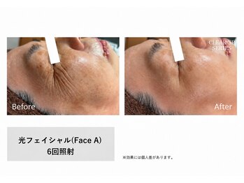 メン脱 三軒茶屋(Men脱)の写真/＜シワ・シミ・くすみケア>脱毛と同時に光フェイシャルで肌質改善★
清潔感あふれる若々しい印象へ！