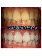 ホワイトニングショップ 大阪玉造店/Before&After美白ホワイトニング