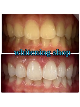 ホワイトニングショップ 大阪玉造店/Before&After美白ホワイトニング