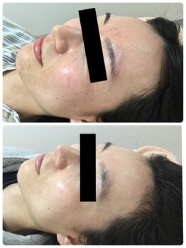 メイユール(MEILLEUR)/光フェイシャル3回