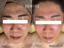 マスカレード 品川(Masquerade)/【ララピール症例写真】