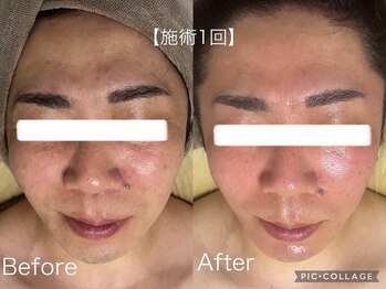 マスカレード 品川(Masquerade)/【ララピール症例写真】