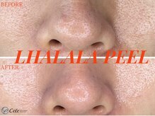 セレ(Cele)/ララピール