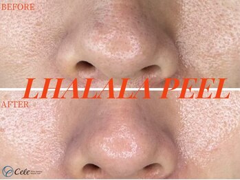 セレ(Cele)/ララピール