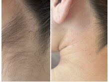 サロン エデンプラス(salon eden PLUS)/うなじワックス