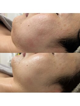 エステサロンブランシュ(Esthe salon Blanche)/ハーブ×ハイパーフェイシャル