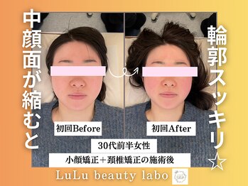 ルルラボ(LuLu beauty labo)/中顔面が整うと輪郭スッキリ