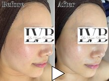 ラヴレボーテ(La Vraie Beaute)/20代・色素 敏感・改善期間2ヶ月
