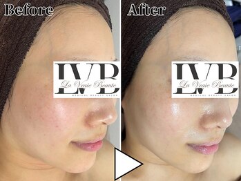ラヴレボーテ(La Vraie Beaute)/20代・色素 敏感・改善期間2ヶ月