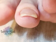 セッテネイル(Sette Nail)/巻き爪ケアもしっかりと☆