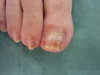 上高田つつじ整体院/痛み解消　巻き爪補正☆