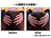 トータルビューティーみつとも/小顔矯正/インディバ/EMS