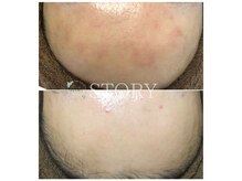 ストーリー(STORY)/ハーブピーリング専門店STORY