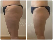 エルール トータルビューティ(Aileure total beauty)/インディバ痩身下半身