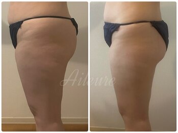 エルール トータルビューティ(Aileure total beauty)/インディバ痩身下半身