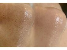 リム(LIMU)の雰囲気（毛穴洗浄で黒ずみや詰まりを解消して毛穴レス美肌に◎）