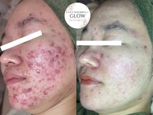 ハーブピーリング/浦和/さいたま新都心/大宮/川口/蕨/与野