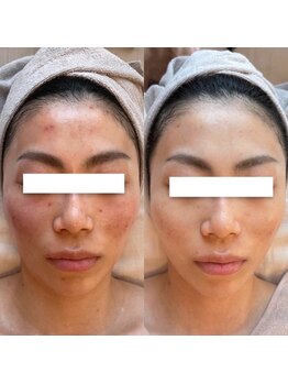 サロン アイプラス(salon i plus)/ニキビ/出来物