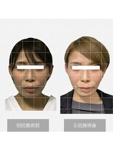 ザ リフト カドモリ 鹿児島 霧島(The Lift KADOMORI)/30代女性/エラ張り