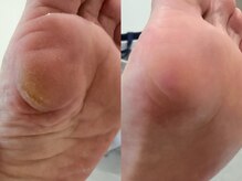 ネイル スパ ココプラス(Nail spa Cocoplus)/硬め角質の角質ケア症例60分