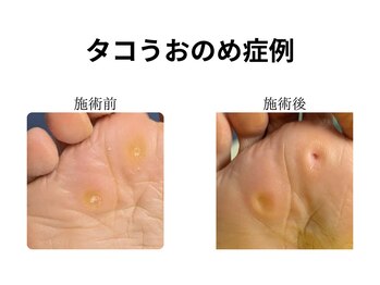 ドクターネイル爪革命 和歌山/胼胝魚の目