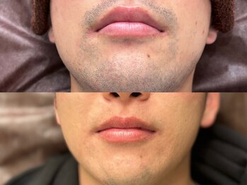 メンズ脱毛サロン ボス(BOSS)/ツルツル卵肌！＃ヒゲ脱毛＃脱毛