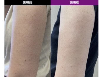 ブルーミントビューティー(blue mint Beauty)/ヒト幹細胞×美肌菌ピーリング