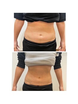 長寿鍼灸院 長寿整骨院/EMS＜お腹集中コース＞