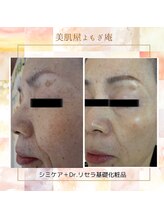 美肌屋よもぎ庵/シミ、たるみ、くすみ