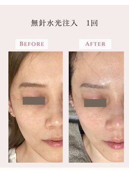 レクラ バイ ドクターエイチ(L'ECLAT by Doctor.H)/無針水光注入”美容液真皮導入”