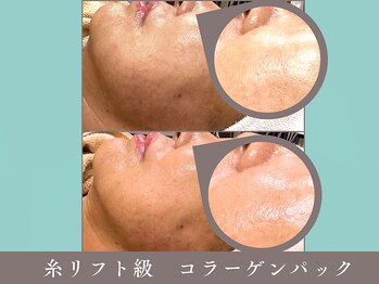 プレジール(plaisir)/糸リフト級のコラーゲンパック