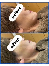 ラピス(Lapis)/【レモンボトル】before.after☆