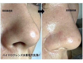 メディカルサロンドオフ 堺東店(medical salon de off)/水素毛穴洗浄♪