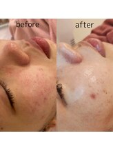 レイネイル レイエステティック 岐阜茜部店(RAY NAIL & RAY ESTHETIC)/肌質改善
